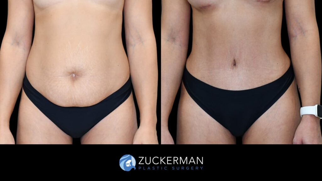Patient before and after Tummy Tuck | Zuckerman Plastic Surgery