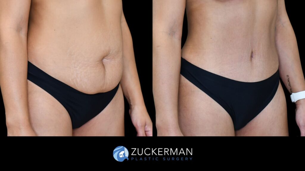 Patient before and after Tummy Tuck | Zuckerman Plastic Surgery