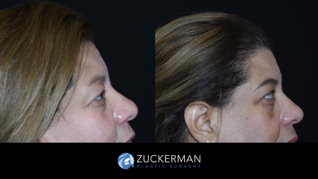 Patient before and after upper eyelid surgery (blepharoplasty) by Dr. Zuckerman, showing lifted and rejuvenated eyelids.