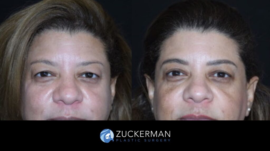 Patient before and after upper eyelid surgery (blepharoplasty) by Dr. Zuckerman, showing lifted and rejuvenated eyelids.