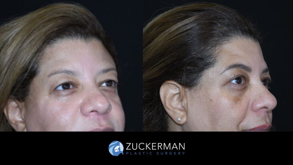 Patient before and after upper eyelid surgery (blepharoplasty) by Dr. Zuckerman, showing lifted and rejuvenated eyelids.
