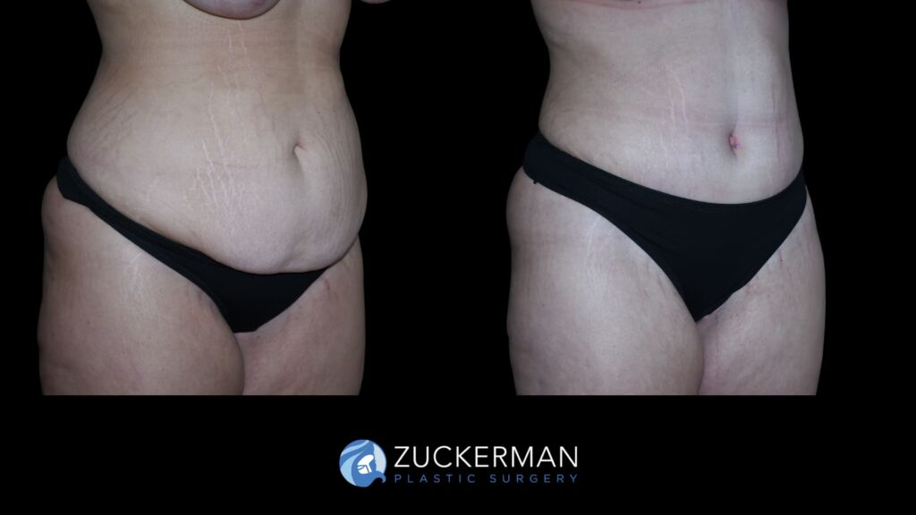 Patient results 7 weeks after tummy tuck performed by Dr. Zuckerman, showing a flatter and more toned abdominal area, right oblique view.