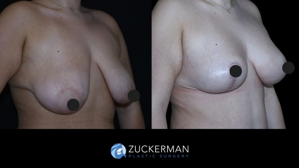 Patient results 7 weeks after augmentation mastopexy with symmetrizing reduction performed by Dr. Zuckerman, showing improved breast shape and symmetry, right oblique view.