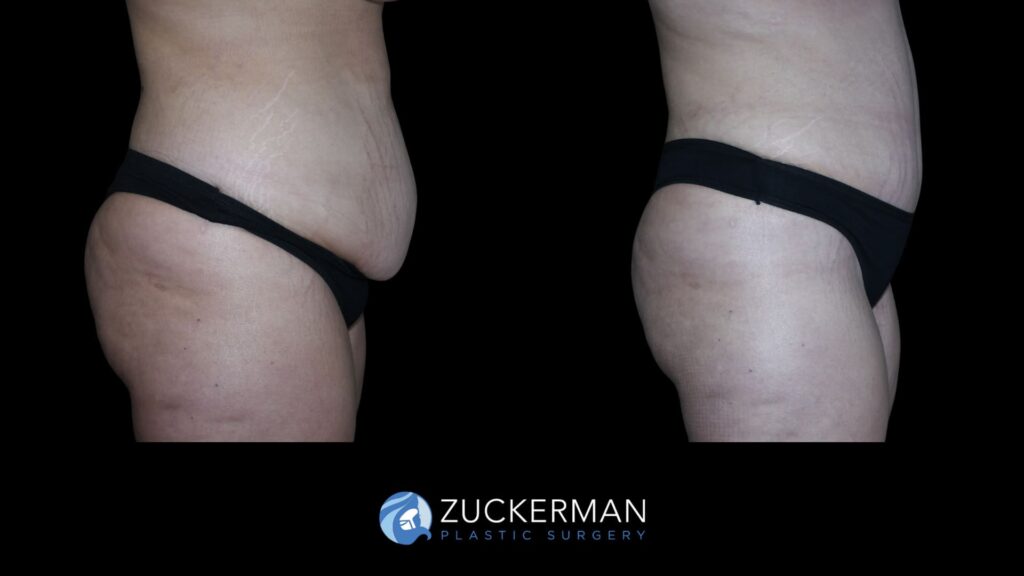 Patient results 7 weeks after tummy tuck performed by Dr. Zuckerman, showing a flatter and more toned abdominal area, right view.