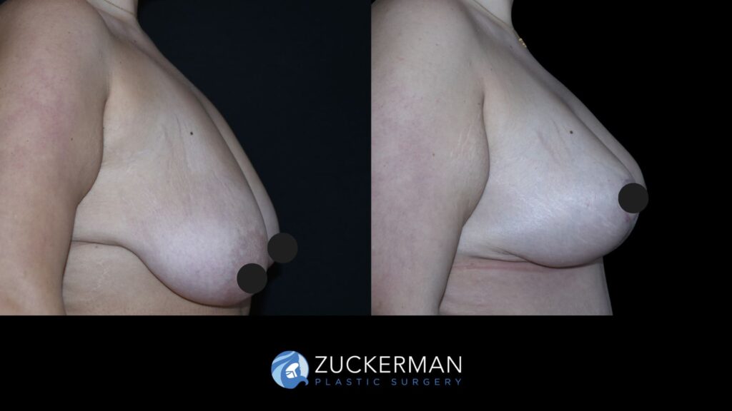 Patient results 7 weeks after augmentation mastopexy with symmetrizing reduction performed by Dr. Zuckerman, showing improved breast shape and symmetry, right view.