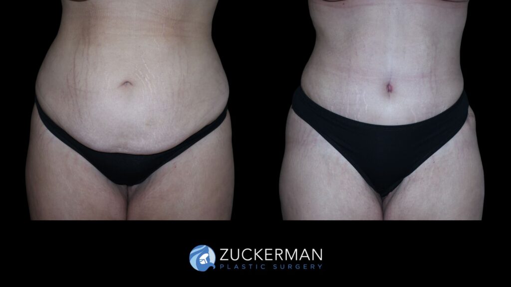 Patient results 7 weeks after tummy tuck performed by Dr. Zuckerman, showing a flatter and more toned abdominal area, front view.