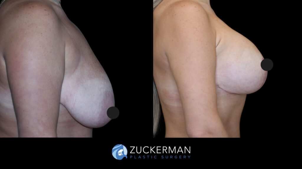 Patient results before and after breast augmentation and lift (augmentation pexy) performed by Dr. Zuckerman, showing enhanced shape and volume of the breasts, right view.