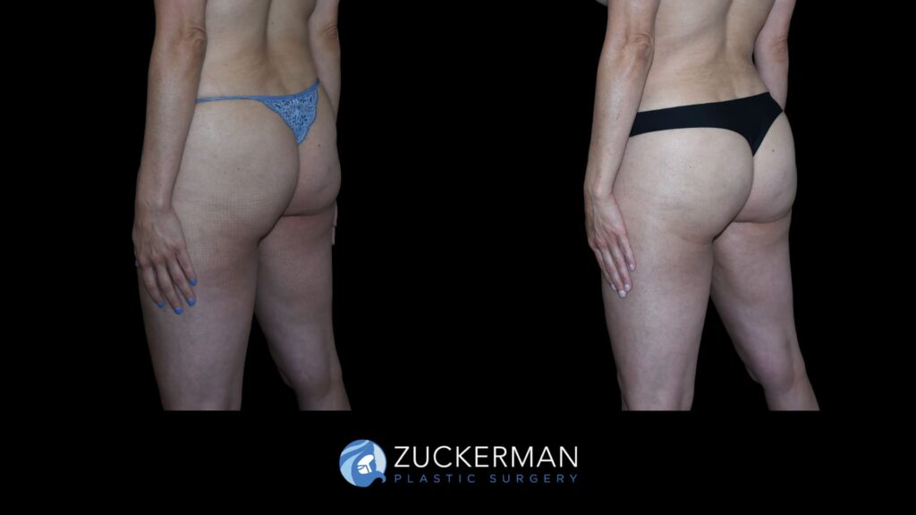 Patient results before and after Brazilian Butt Lift (BBL) performed by Dr. Zuckerman, showing improved contour and volume of the buttocks, front view.