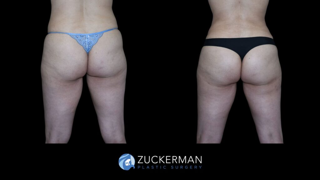Patient results before and after Brazilian Butt Lift (BBL) performed by Dr. Zuckerman, showing improved contour and volume of the buttocks, front view.