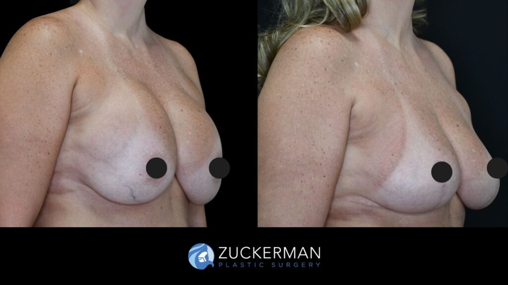 Patient results before and after revision breast surgery including implant exchange, capsulectomy, and mastopexy performed by Dr. Zuckerman, female patient, 7 weeks postop, showing improved breast shape and symmetry, right oblique view.