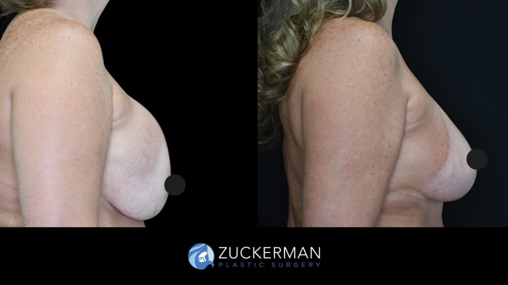 Patient results before and after revision breast surgery including implant exchange, capsulectomy, and mastopexy performed by Dr. Zuckerman, female patient, 7 weeks postop, showing improved breast shape and symmetry, right oblique view.