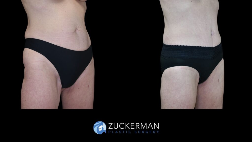 Patient results before and after circumferential body contouring performed by Dr. Zuckerman, right oblique view.