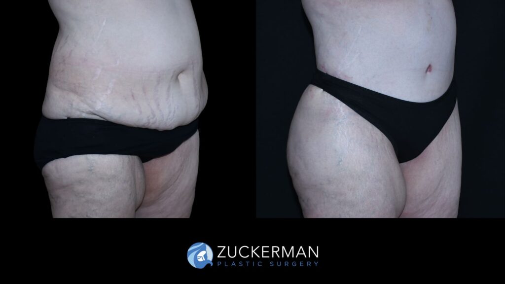 Side-by-side comparison of a patient before and after circumferential body contouring performed by Dr. Zuckerman, right oblique view.