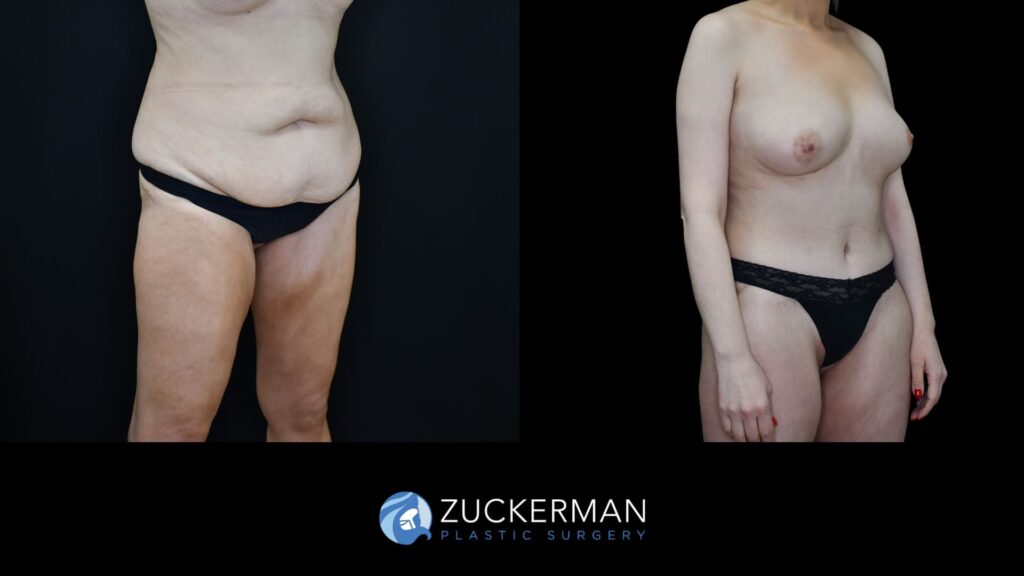 Before and after circumferential body contouring by Dr. Zuckerman, right oblique view.