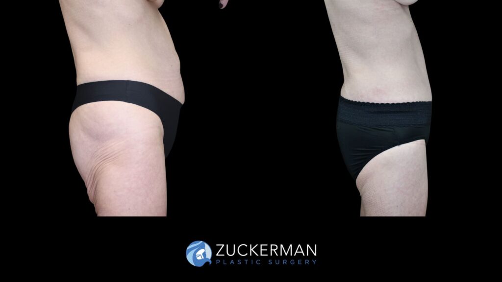 Patient results before and after circumferential body contouring performed by Dr. Zuckerman, left view.