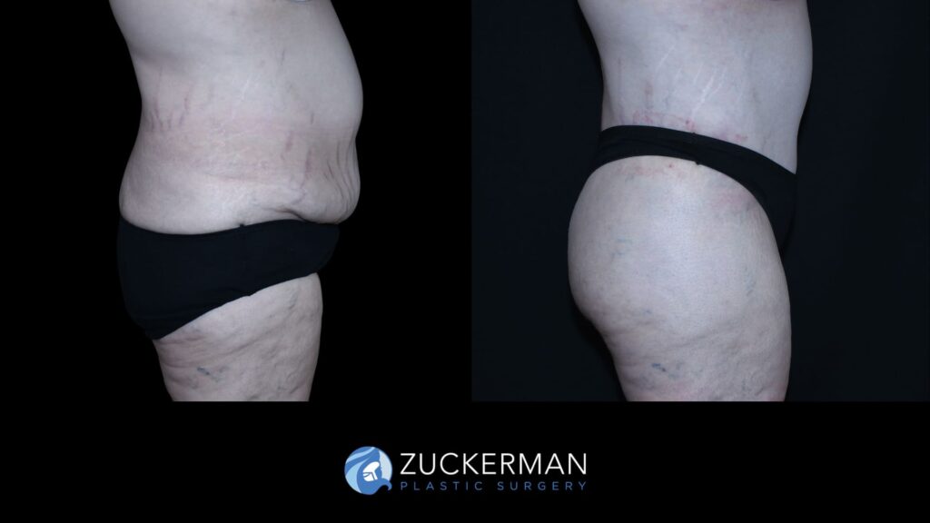 Side-by-side comparison of a patient before and after circumferential body contouring performed by Dr. Zuckerman, right view.
