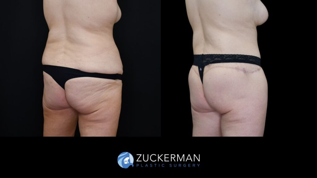Before and after circumferential body contouring by Dr. Zuckerman, right oblique back view.