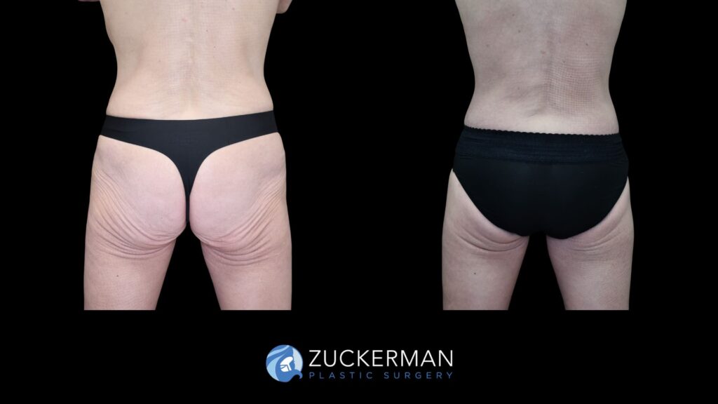Patient results before and after circumferential body contouring performed by Dr. Zuckerman, back view.