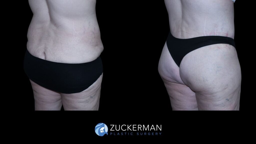 Side-by-side comparison of a patient before and after circumferential body contouring performed by Dr. Zuckerman, right oblique back view.