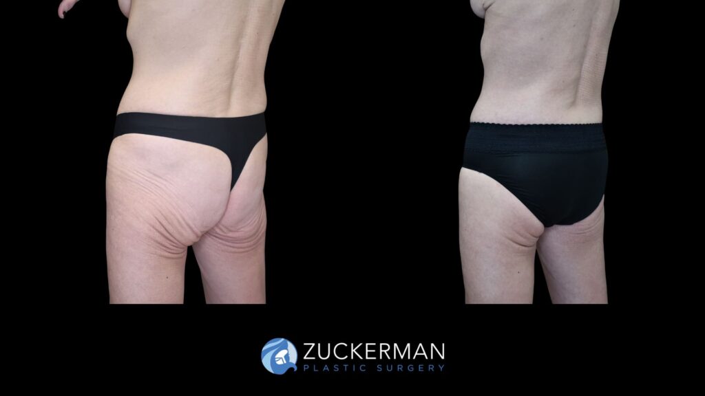Patient results before and after circumferential body contouring performed by Dr. Zuckerman, left oblique back view.