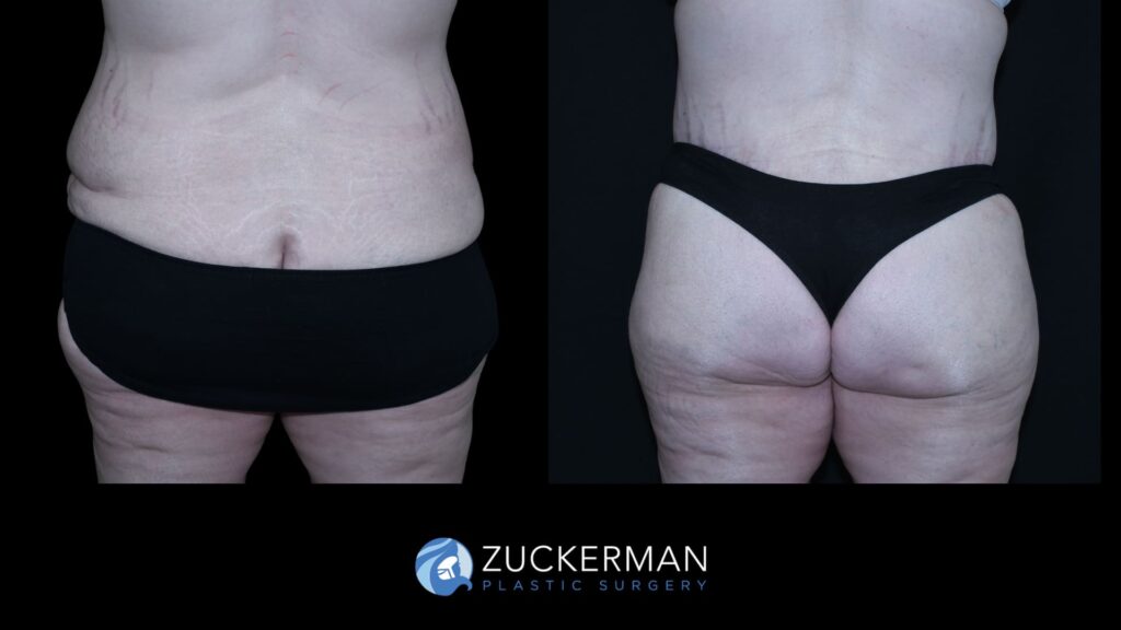 Side-by-side comparison of a patient before and after circumferential body contouring performed by Dr. Zuckerman, back view.