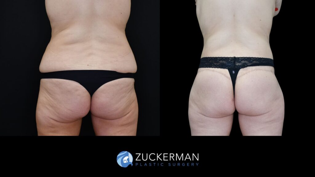 Before and after circumferential body contouring by Dr. Zuckerman, back view.