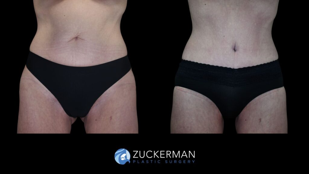 Patient results before and after circumferential body contouring performed by Dr. Zuckerman, front view.