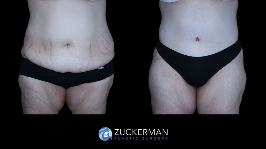 Side-by-side comparison of a patient before and after circumferential body contouring performed by Dr. Zuckerman, front view.