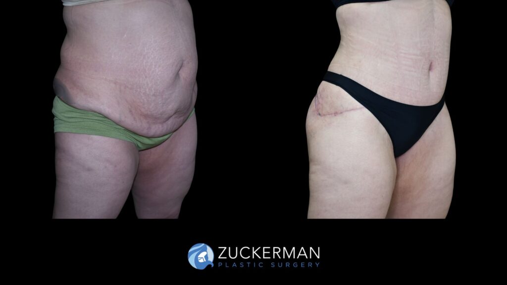 Patient results before and after circumferential lift following weight loss performed by Dr. Zuckerman, focusing on the buttocks area, right oblique view.