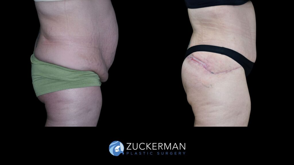 Patient results before and after circumferential lift following weight loss performed by Dr. Zuckerman, focusing on the buttocks area, right view.