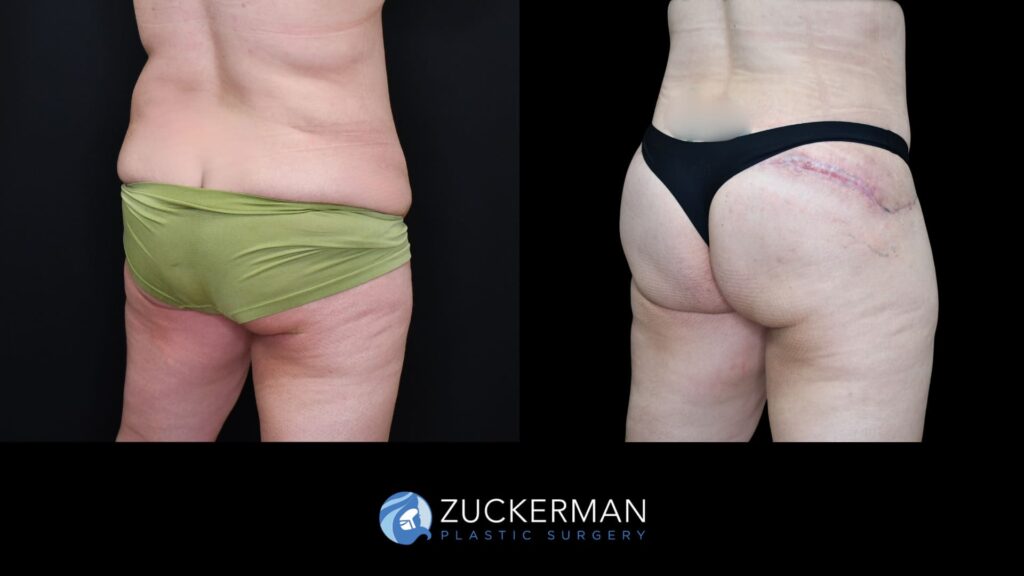 Patient results before and after circumferential lift following weight loss performed by Dr. Zuckerman, focusing on the buttocks area, right oblique back view.