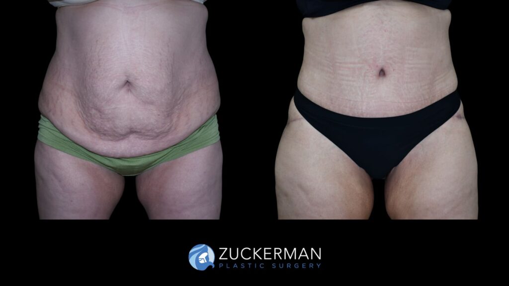 Patient results before and after circumferential lift following weight loss performed by Dr. Zuckerman, focusing on the buttocks area, front view.
