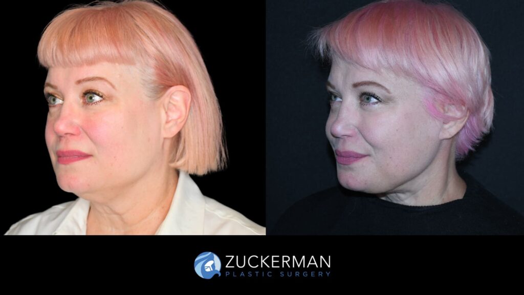 Patient results before and after facelift performed by Dr. Zuckerman, showing a smoother and more youthful facial appearance, left oblique view.