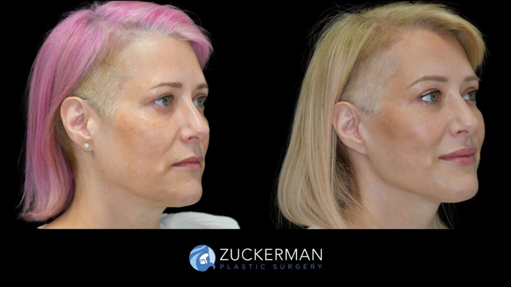 Patient results before and after facelift and brow lift performed by Dr. Zuckerman, showing a rejuvenated facial appearance and lifted brow area, right oblique view.