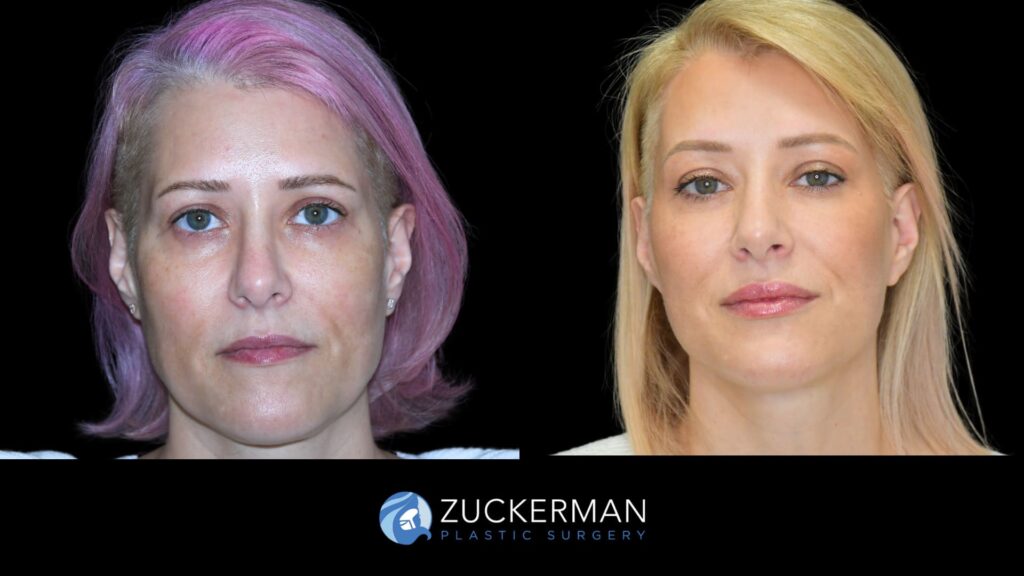 Patient results before and after facelift and brow lift performed by Dr. Zuckerman, showing a rejuvenated facial appearance and lifted brow area, front view.