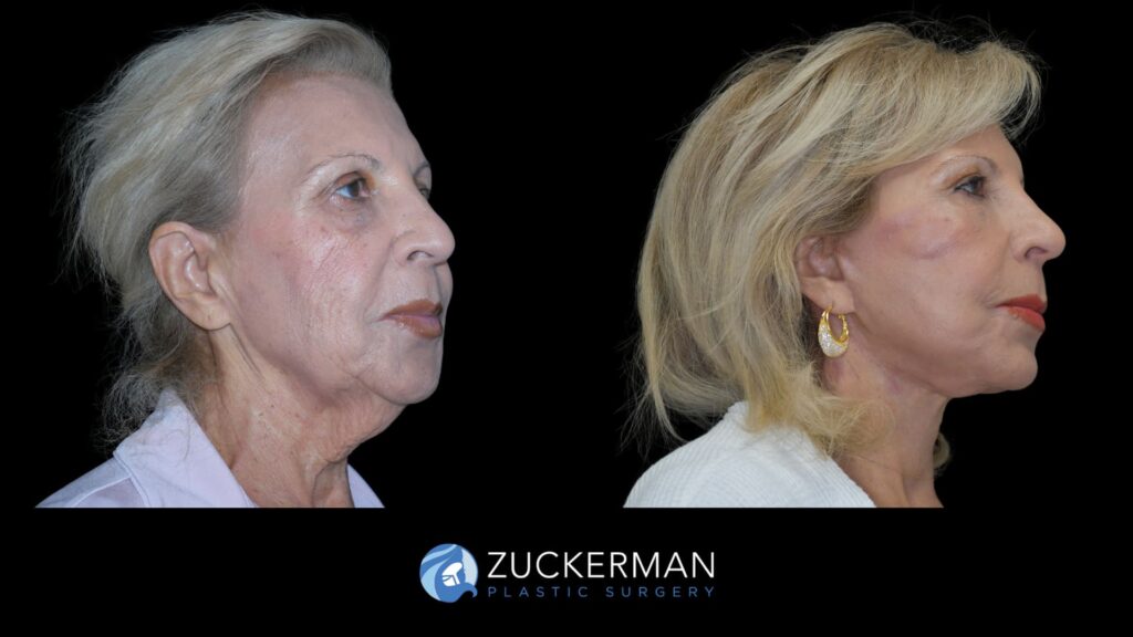 Patient results before and after face and neck lift performed by Dr. Zuckerman, showing a more defined jawline and smoother neck appearance, right oblique view.