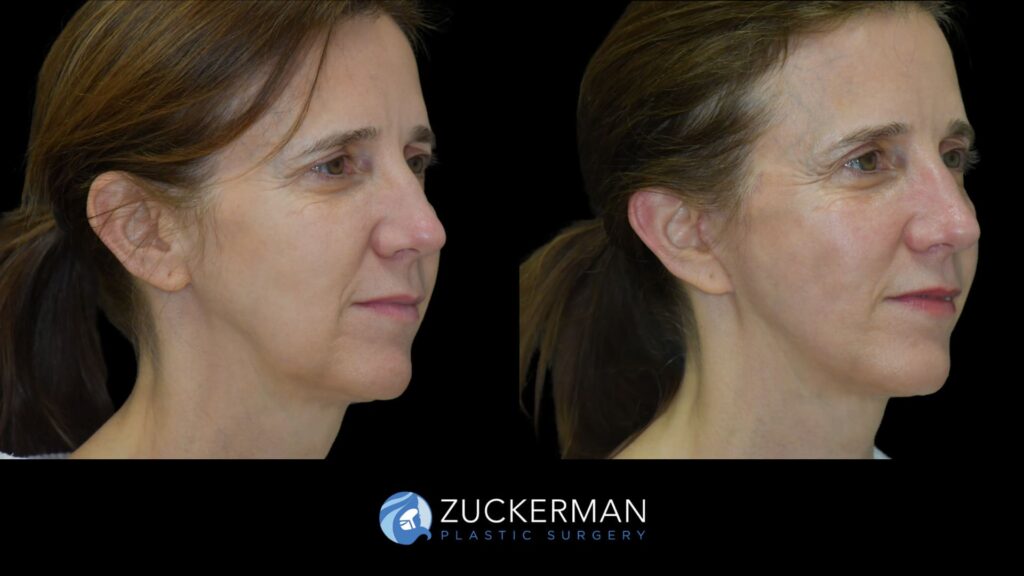Patient results before and after facelift performed by Dr. Zuckerman, showing smoother skin and improved facial contour, right oblique view.