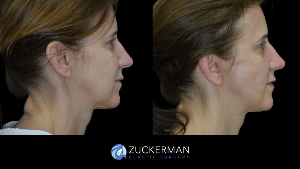 Patient results before and after facelift performed by Dr. Zuckerman, showing smoother skin and improved facial contour, right view.