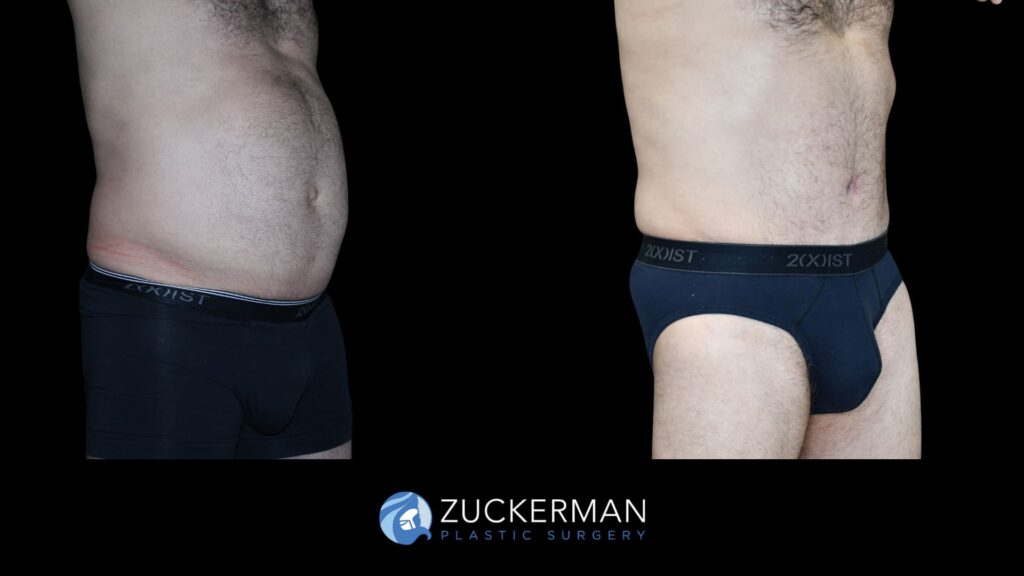 Patient results before and after male tummy tuck performed by Dr. Zuckerman, showing a flatter and more toned abdominal area, right oblique view.