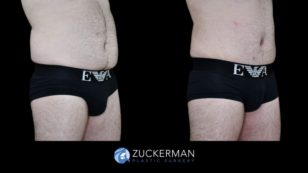 Patient results before and after male tummy tuck performed by Dr. Zuckerman, showing a flatter and more toned abdominal area, right oblique view.