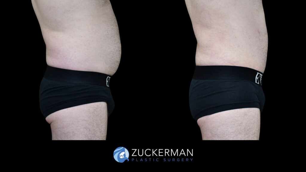 Patient results before and after male tummy tuck performed by Dr. Zuckerman, showing a flatter and more toned abdominal area, right view.
