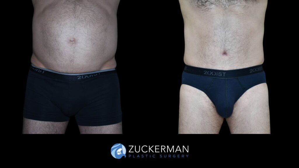 Patient results before and after male tummy tuck performed by Dr. Zuckerman, showing a flatter and more toned abdominal area, front view.