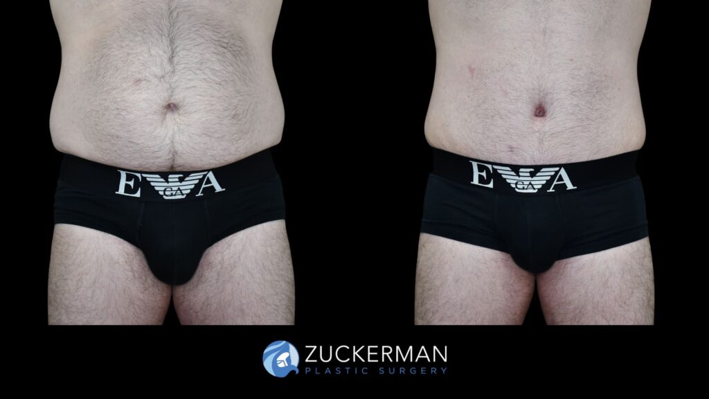 Patient results before and after male tummy tuck performed by Dr. Zuckerman, showing a flatter and more toned abdominal area, front view.