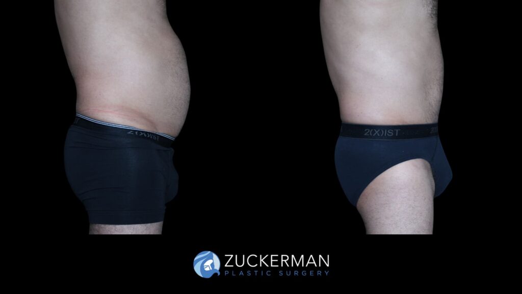 Patient results before and after male tummy tuck performed by Dr. Zuckerman, showing a flatter and more toned abdominal area, right view.