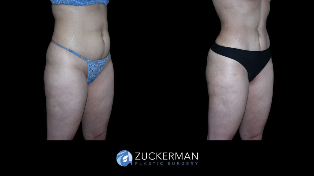 Patient results before and after mini tummy tuck performed by Dr. Zuckerman, showing a flatter and more toned abdominal area, right oblique view.