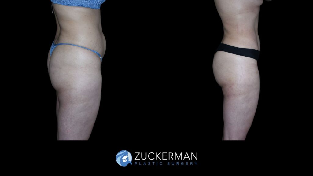 Patient results before and after mini tummy tuck performed by Dr. Zuckerman, showing a flatter and more toned abdominal area, right view.