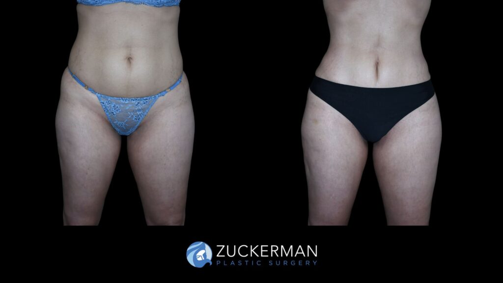 Patient results before and after mini tummy tuck performed by Dr. Zuckerman, showing a flatter and more toned abdominal area, front view.