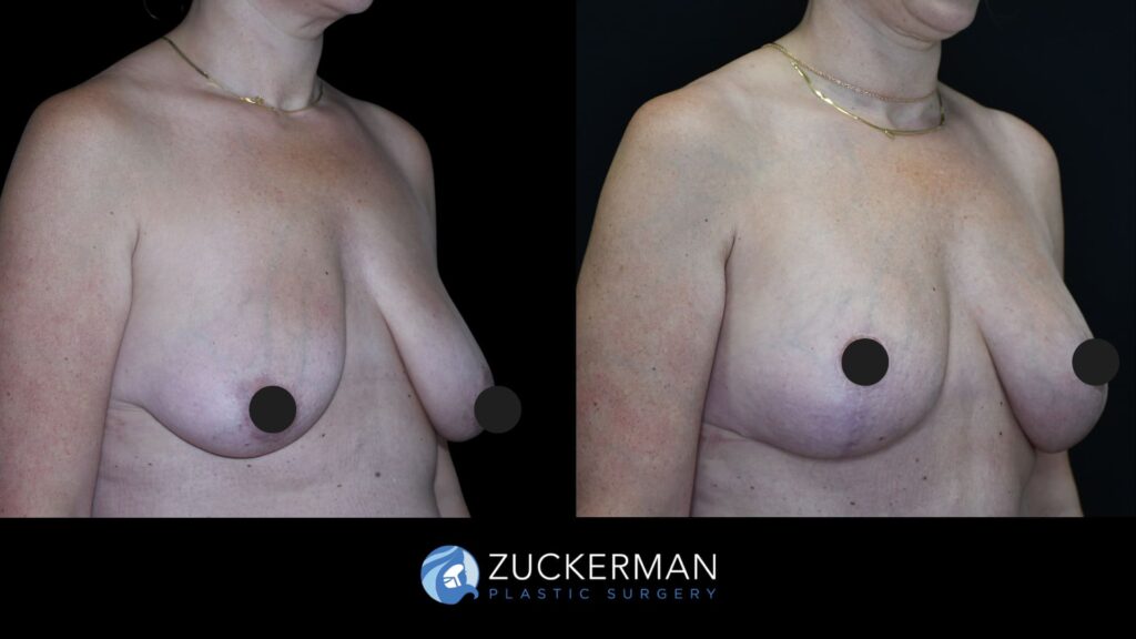 Patient results from Mommy Makeover performed by Dr. Zuckerman, showing mastopexy results and improved breast shape and volume, right oblique view.