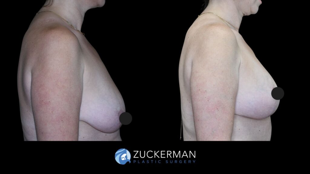 Patient results from Mommy Makeover performed by Dr. Zuckerman, showing mastopexy results and improved breast shape and volume, right view.