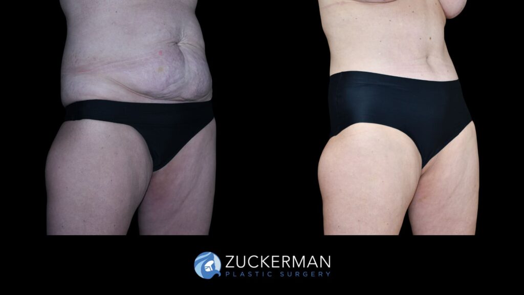 Patient results from Mommy Makeover performed by Dr. Zuckerman, showing tummy tuck results and a flatter, more toned abdominal area, right oblique view.